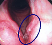 初期の喉頭癌